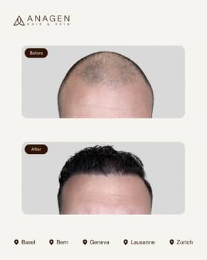 Slider image (6) Anagen - Hair Transplant Clinic in Switzerland